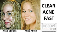 Load image into Gallery viewer, Sulfur Soap for Acne Pharmaceutical Grade Dermatologists FDA Approved for Acne Rosacea 100G