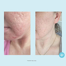 Load image into Gallery viewer, Glycolic Acid 50% Gel Peel - Enhanced with Retinol & Green Tea Extract (Professional Skin Peel)1 ounce