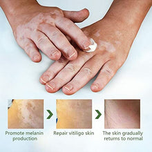 Load image into Gallery viewer, ZCXZ 6PCS White Tag Treatment Moisturizing Cream, Vitiligo Cream for White Spots On Skin, Improve Skin Pigmentation, Reduces Leukoplakia