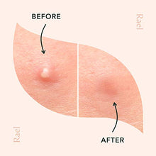 Load image into Gallery viewer, Rael Acne Pimple Healing Patch - Absorbing Cover, Invisible, Blemish Spot, Hydrocolloid, Skin Treatment, Facial Stickers, Two Sizes 10mm & 12mm, Blends in with skin (96 Count)