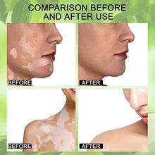 Load image into Gallery viewer, ZCXZ 6PCS White Tag Treatment Moisturizing Cream, Vitiligo Cream for White Spots On Skin, Improve Skin Pigmentation, Reduces Leukoplakia