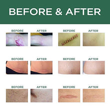 Load image into Gallery viewer, Scar Removal Cream Advanced Treatment for Old & New Scars from Cuts Stretch Marks, C-Sections & Surgeries With Natural Herbal Extracts Formula
