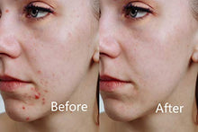 Load image into Gallery viewer, FDA cleared|Aphrona LED Facial Skin Care Mask Light Treatment LED Mask