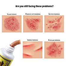 Load image into Gallery viewer, 5pcs New Chinese Herbal Eczema Psoriasis Creams Dermatitis and Eczema Pruritus Psoriasis Ointment