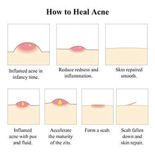 Load image into Gallery viewer, Acne Treatment Serum, BREYLEE Tea Tree Clear Skin Serum for Clearing Severe Acne, Breakout, Remover Pimple and Repair Skin (17ml,0.6oz)