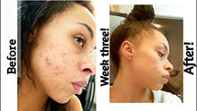 Load image into Gallery viewer, The Ordinary Retinol 1% in Squalane 30ml