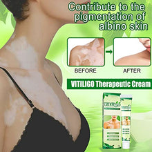 Load image into Gallery viewer, ZCXZ 6PCS White Tag Treatment Moisturizing Cream, Vitiligo Cream for White Spots On Skin, Improve Skin Pigmentation, Reduces Leukoplakia