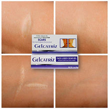 Load image into Gallery viewer, Gelcatriz Scar Treatment Gel | Scar Removal Gel for Diminishing the Visible Appearance of Acne Scars, Surgery Scars, Stretch Marks, Cuts & Scrapes, and more; 1 Ounce Tube