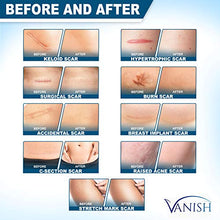 Load image into Gallery viewer, Vanish Silicone Scar Gel Medical-Grade Silicone Cream for Face, Body, Stretch Marks, C-Sections, Surgical, Burn, Acne | Old & New Scars, Clinically Proven | 30g