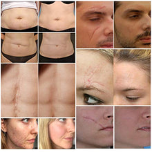 Load image into Gallery viewer, Scar Remover Cream, Reduce and Repair Skin, from C-Section, Acne, Surgery, Burns, Face Sacne, Effective for both Old and New Scars, Best Scar Removal Cream for Kids, Women, Men, 50Ml