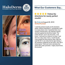 Load image into Gallery viewer, HaloDerm Advanced Skin Tag Remover & Mole Remover - All Natural Skin Tag Cream - Remove up to 10 Skin Tags (FAST Results In As Little As 3-5 Applications) (1 Pack)