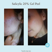 Load image into Gallery viewer, Salicylic 20% Gel Peel, Breakout and Pore Minimizer and Cleanser, Strength Level 2, 15-30 Full Facial Chemical Peels, 1 fl oz. e, 30 ml
