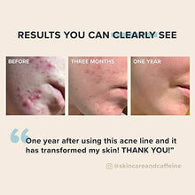 Load image into Gallery viewer, Paula's Choice CLEAR Regular Strength Acne Kit, 2% Salicylic Acid &amp; 2.5% Benzoyl Peroxide for Facial Acne &amp; Pores, Redness Relief, PACKAGING MAY VARY
