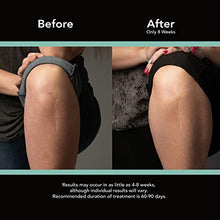 Load image into Gallery viewer, ScarAway Advanced Skincare Long Silicone Scar Sheets for Hypertrophic Scars and Keloids Caused by Surgery, Injury, Burns, C-Section and More, 1.5" x 7", 6 Sheets
