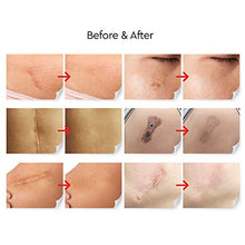 Load image into Gallery viewer, LUXROS Advanced Surgical Scar Remover Gel for Old and New Scars - Medical Grade Silicone Gel to Remove Scars from Surgery, Injury, Burns, Acne - 25g - Reduces Appearance of Keloid Scars
