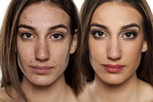 Load image into Gallery viewer, Acne spot Treatment Skin Serum Vitamin C, E and niacin amide Vitamin B3, B5, Acscanex for scars remove 50ML plus Face Cleanser 120Ml FREE
