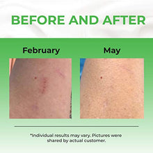 Load image into Gallery viewer, Scar Gel Reduce the Appearance of Old and New Scars - Acne, Burns, Cuts, Stretch Marks, C Section Marks &amp; Plastic Surgery - Advanced Face and Body Formula, Men and Women Pureauty Naturals - 59ml
