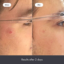Load image into Gallery viewer, Rescue Balm Post-Blemish Recovery Cream from Hero Cosmetics - Intensive Nourishing and Calming for Dry, Red-Looking Skin After a Blemish - Dermatologist Tested and Vegan-Friendly (15 ml, 0.5 fl. oz)
