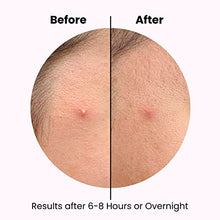 Load image into Gallery viewer, Hydrocolloid Acne Pimples Patches Invisible Spot Cover Blemish Spot Absorbing Cover Facial Skin Care Products
