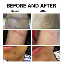 Load image into Gallery viewer, Lancs Acne Scar Removal Serum Skin Repair Essence for Reduces the Appearance of Old &amp; New Scars, Wrinkles, Burns and Recovery Scar Treatment (5ml7 bottles)

