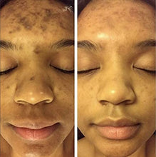 Load image into Gallery viewer, Potent Dark Spot Corrector Remover For Face &amp; Retinol Cream Provides the Most Effective Combination For Fading &amp; Removing Dark Spots
