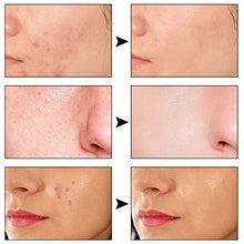 Load image into Gallery viewer, Facial Serum, Acne Scar Treatment, Face Essence, Scar Fade Serum, Moisturizing Serum, Acne Treatment Serum, Moisturizing and Hydrating, Anti-Wrinkle,Anti-Aging,Firm and Lift Skin,Remove Acne, Scar
