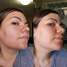 Load image into Gallery viewer, MSM Cream Rosacea Eczema Psoriasis Scars
