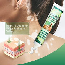 Load image into Gallery viewer, ZCXZ 6PCS White Tag Treatment Moisturizing Cream, Vitiligo Cream for White Spots On Skin, Improve Skin Pigmentation, Reduces Leukoplakia
