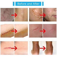 Load image into Gallery viewer, Silicone Scar Gel-Kinbeau Scar Remover Gel for Face, Body, C-Section Stretch Marks, Surgical, Burn, Acne, Old &amp; New Scars,30g/1 OZ (white blue)
