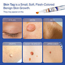 Load image into Gallery viewer, Reejoys Skin Tag &amp; Mole Removal - Safe &amp; Effective Formula for Skin Tag Remover (4 Packs)
