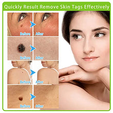 Load image into Gallery viewer, 2 in 1 Skin Tag Remover - Auto Skin Tag Remover Pen Removal Kit Products Tool with 40 Micro and Regular Skin Tag Bands, User-Friendly, Safe and Painless Remove Small to Large (2mm-8mm) Sized Skin Tag
