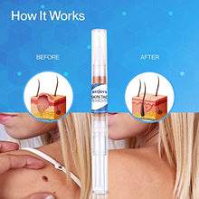Load image into Gallery viewer, Reejoys Skin Tag &amp; Mole Removal - Safe &amp; Effective Formula for Skin Tag Remover (4 Packs)
