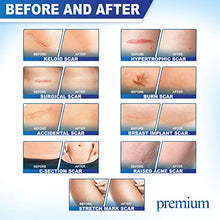 Load image into Gallery viewer, Premium Advanced Scar Gel Medical-Grade Silicone for Face, Body, Stretch Marks, C-Sections, Surgical, Burn, Acne | Old &amp; New Scars, Clinically Proven | 30g
