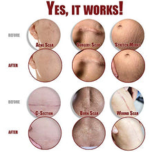 Load image into Gallery viewer, Ebanel Advanced Silicone Scar Gel, Scar Removal Cream for Old &amp; New Scars of Acne, Surgical, C-Section, Injuries, Burn, Cuts, Insect Bites, Stretch Marks with Vitamin E, Emu Oil, Onion Extract
