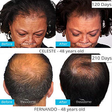 Load image into Gallery viewer, Theradome PRO LH80 - Medical Grade Laser Hair Growth Helmet - FDA Cleared for Men &amp; Women. Promotes Hair Regrowth and Prevents Further Hair Loss with Premium Red Light Lasers
