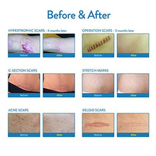 Load image into Gallery viewer, Aroamas, Silicone Scar Removal Sheets - for Keloid, C-Section, Hypertrophic, Surgical Scars and More Reusable and Washable 3"×1.57", 4 Sheets (2 Month Supply)
