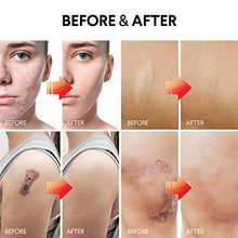 Load image into Gallery viewer, Scar Removal Cream, Scar Cream For Old Scars - Stretch Mark Removal Cream for Men &amp; Women - Stretch Marks Relief and Burns Repair, Face Skin Repair Cream
