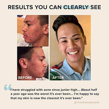 Load image into Gallery viewer, Paula's Choice CLEAR Extra Strength Acne Kit, 2% Salicylic Acid &amp; 5% Benzoyl Peroxide for Severe Acne, Redness Relief, PACKAGING MAY VARY
